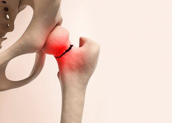 Novo tratamento para osteoporose vem aí