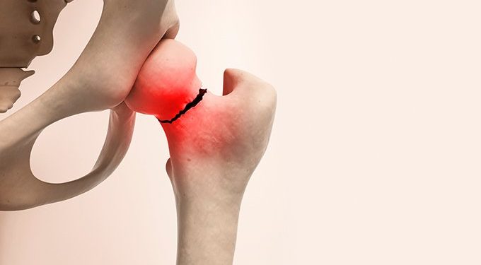 Novo tratamento para osteoporose vem aí