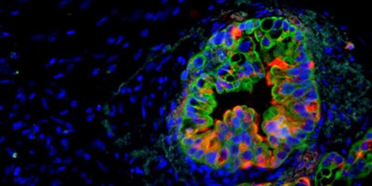 Cientista brasileira cria ‘caneta’ que detecta câncer durante cirurgia