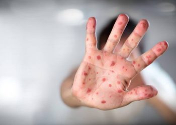 Sarampo: capital paulista registra 1º caso autóctone em quatro anos