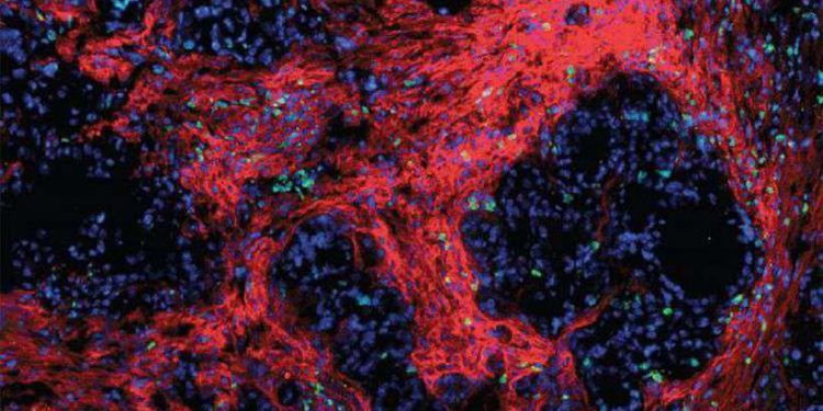 Novo tratamento se mostra promissor contra o câncer de pâncreas
