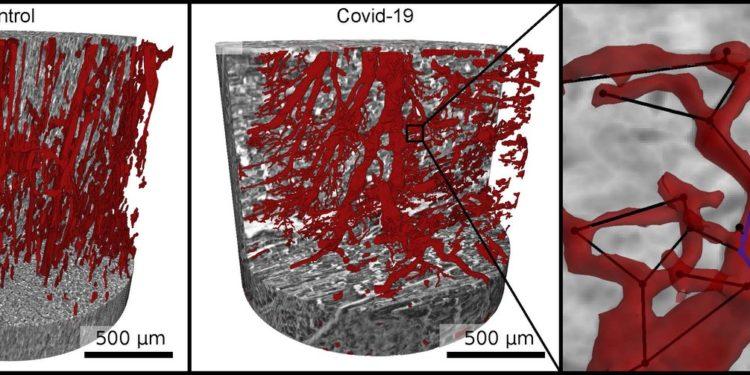 Imagens de raios-X revelam danos do Sars-CoV-2 ao coração