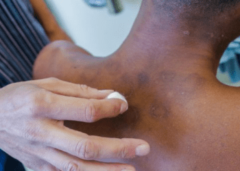 Janeiro Roxo alerta para a conscientização sobre a hanseníase