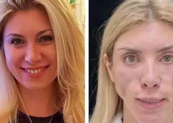 Após plásticas, Miss tem rosto desfigurado e não consegue fechar os olhos