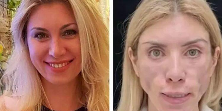 Após plásticas, Miss tem rosto desfigurado e não consegue fechar os olhos