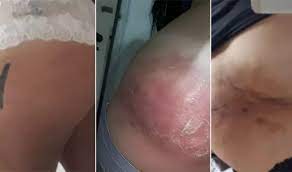 SP: mulher tem infecção grave e fica com bumbum deformado após injeção