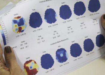 Março Roxo quer conscientizar população sobre a epilepsia