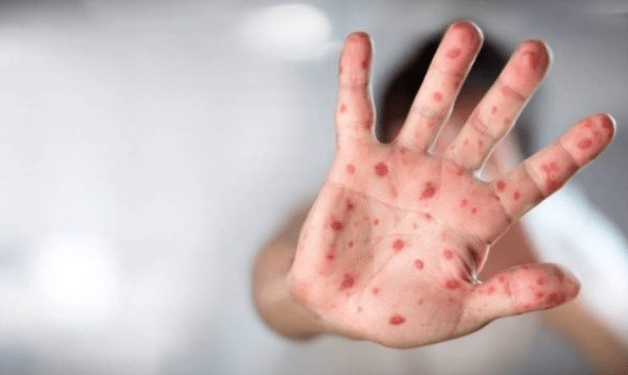 Sarampo: 3º caso desde fevereiro alerta São Paulo para risco de surto