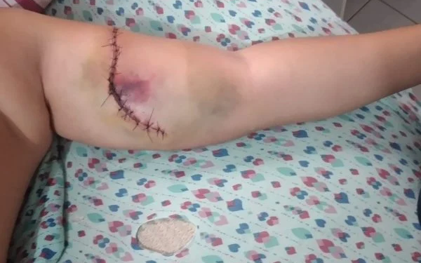 Menino tem braço rasgado em acidente na quadra de escola pública do DF