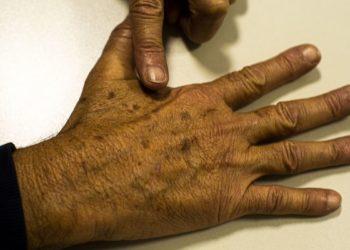 Ministério da Saúde abre consulta sobre diagnóstico do câncer de pele