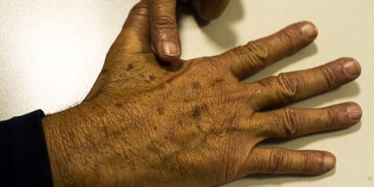 Ministério da Saúde abre consulta sobre diagnóstico do câncer de pele