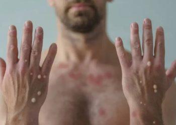 Varíola dos macacos: 3 erros cometidos em epidemias do passado que podem ser evitados no surto atual