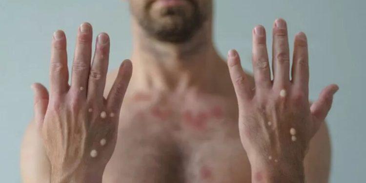 Varíola dos macacos: 3 erros cometidos em epidemias do passado que podem ser evitados no surto atual