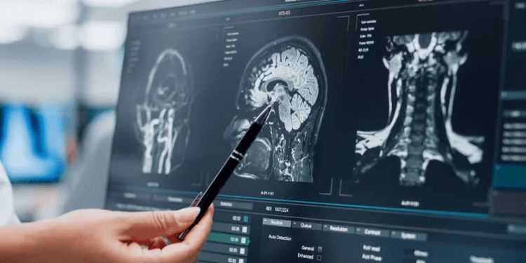 Método consegue detectar Alzheimer com apenas uma ressonância magnética