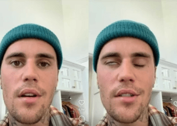 Justin Bieber aparece com metade do rosto paralisado: “Eu confio em Deus”