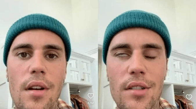 Justin Bieber aparece com metade do rosto paralisado: “Eu confio em Deus”