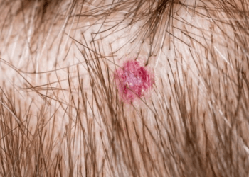 ‘Cabeleireiro viu mancha e me alertou para câncer’