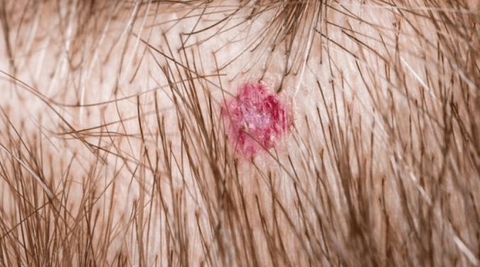 ‘Cabeleireiro viu mancha e me alertou para câncer’