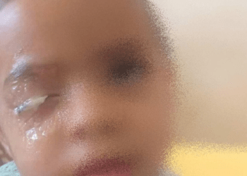 Criança que grudou olho com super cola não precisará de cirurgia