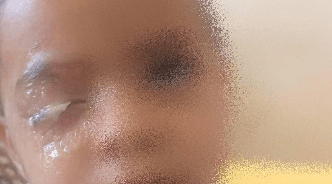 Criança que grudou olho com super cola não precisará de cirurgia