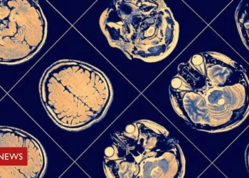 Pesadelos frequentes podem ser sinal de Parkinson, diz estudo