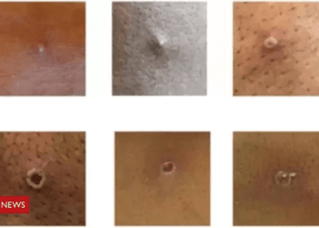 Brasil confirma 6º caso de varíola dos macacos; o que se sabe até o momento