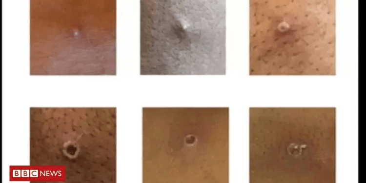 Brasil confirma 6º caso de varíola dos macacos; o que se sabe até o momento