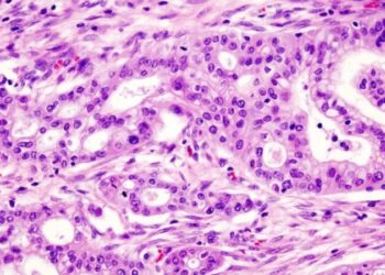 Técnica reverte agressividade do câncer de pâncreas