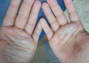 Mãe é presa após queimar mãos de criança com colher quente em Manaus