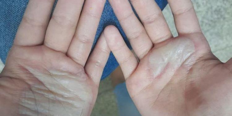 Mãe é presa após queimar mãos de criança com colher quente em Manaus