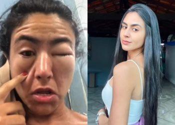 Estudante fica com o rosto deformado após reação alérgica a camarão, na zona Sul do Rio de Janeiro. 
