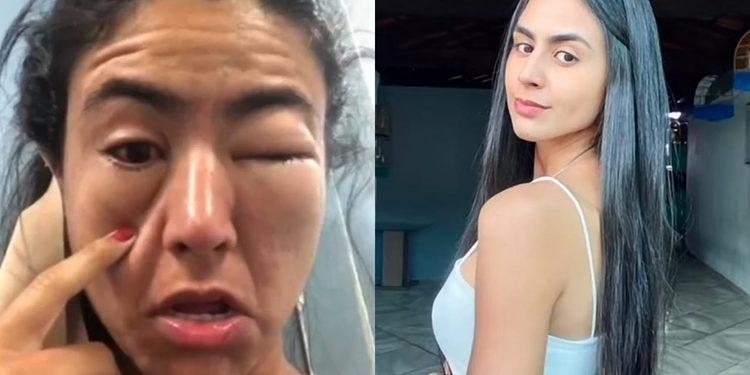 Estudante fica com o rosto deformado após reação alérgica a camarão, na zona Sul do Rio de Janeiro. 