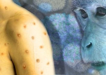 Brasil tem mais de 200 casos confirmados de varíola dos macacos