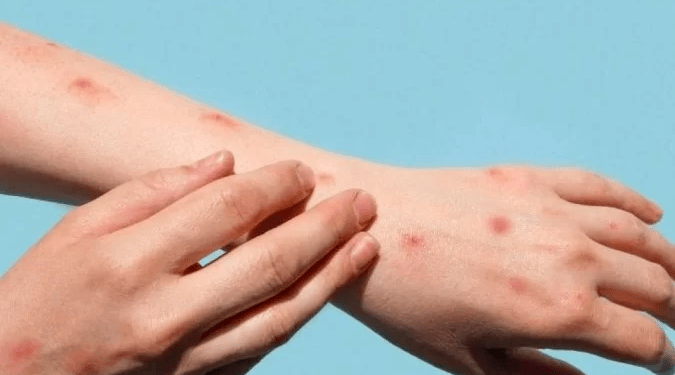 Varíola dos macacos: casos crescem 74% em 2 semanas e Brasil lidera alta