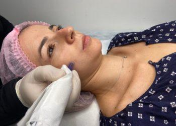Skinbooster é alternativa para recuperar a pele durante a seca