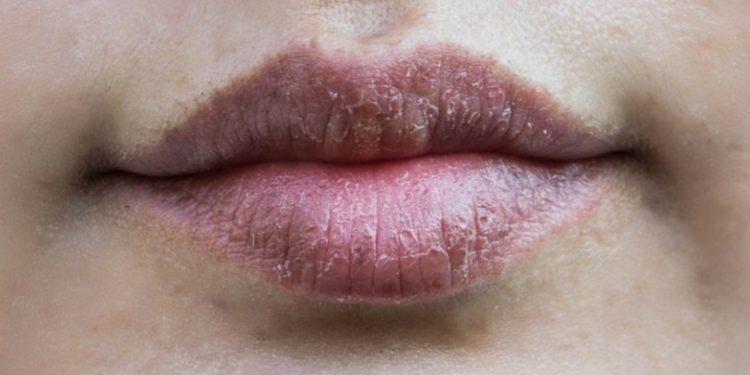 Lábios na seca: como protegê-los?