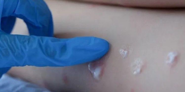 Amazonas confirma 4º caso de infecção por varíola dos macacos