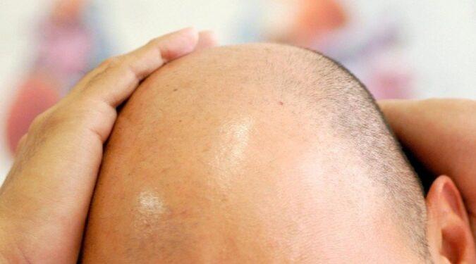 Pesquisadores estudam nova estratégia contra a calvície; entenda