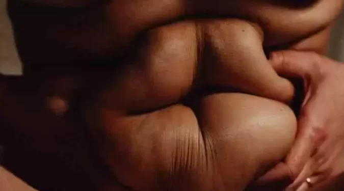 Balão intragástrico e cirurgia bariátrica: indicações de cada procedimento