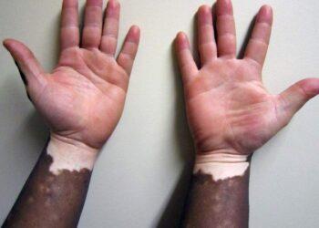 Pomada com ruxolitinibe ameniza vitiligo em até 75%, diz estudo