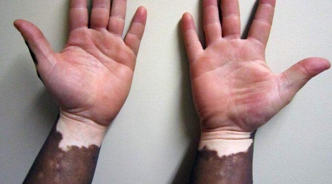 Pomada com ruxolitinibe ameniza vitiligo em até 75%, diz estudo