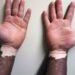 Pomada com ruxolitinibe ameniza vitiligo em até 75%, diz estudo
