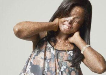 Xeroderma pigmentoso: ‘Troco dia pela noite’, diz mulher que sofre com doença rara