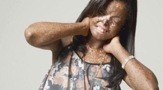 Xeroderma pigmentoso: ‘Troco dia pela noite’, diz mulher que sofre com doença rara