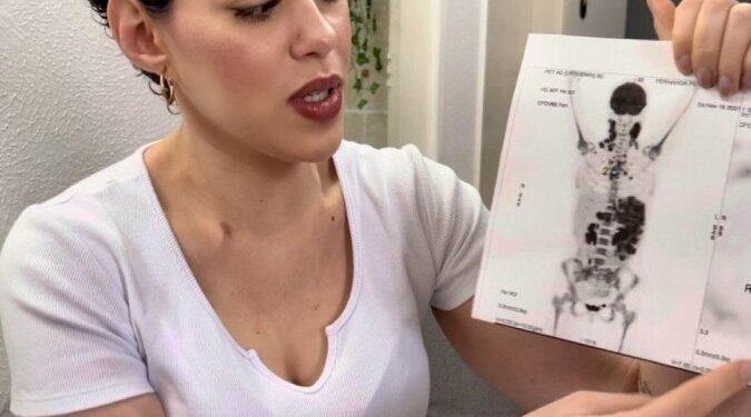 ‘Passei por seis médicos até descobrir câncer aos 25 anos’