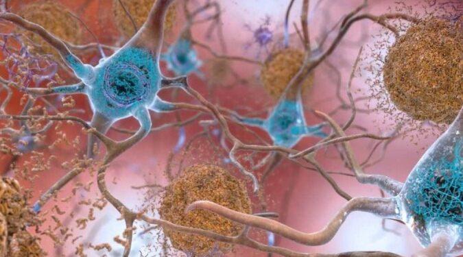 Medicamento que age em causas do Alzheimer tem resultado limitado
