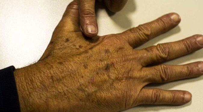 Campanha sobre o câncer de pele chama atenção para os sinais de alerta