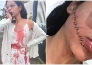 Jovem tem rosto cortado na Bahia enquanto dormia em viagem de ônibus