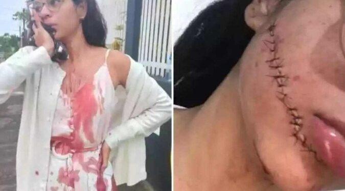 Jovem tem rosto cortado na Bahia enquanto dormia em viagem de ônibus