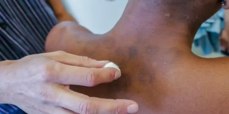 Hanseníase: pacientes contam histórias de preconceito e superação